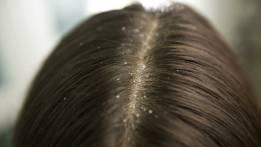 dandruff